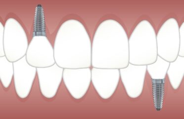 Ugradnja zubnih implantata, Split – Ordinacija NENAD ŠARIĆ dr.med.dent.